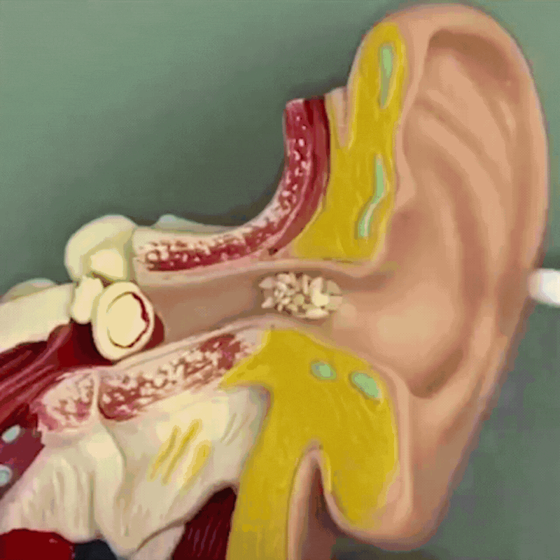 Earwax Vacuum – Safe & Painless Cleaning