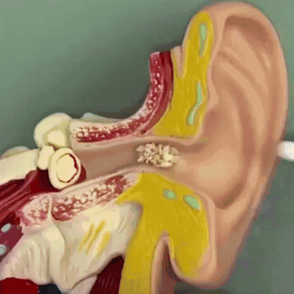 Earwax Vacuum – Safe & Painless Cleaning