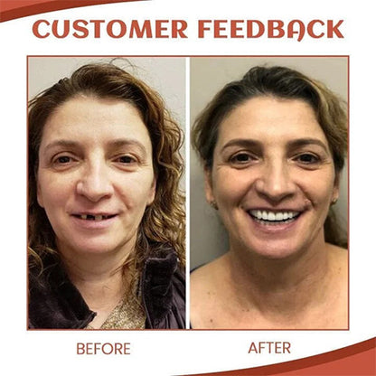 Custom Fit Denture Kit – Easy DIY Solution