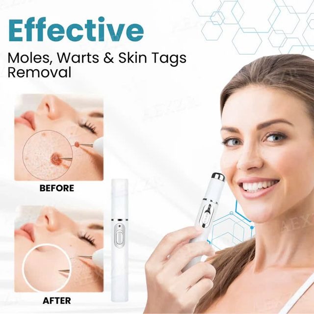 Laser Pen - Non-Invasive Mole and Wart Removal