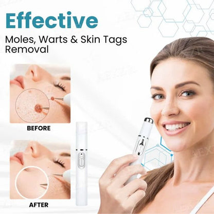 Laser Pen - Non-Invasive Mole and Wart Removal