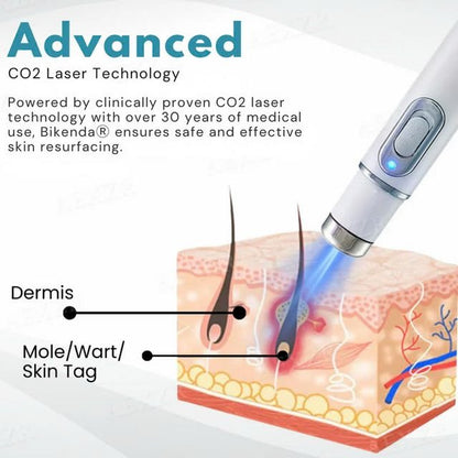 Laser Pen - Non-Invasive Mole and Wart Removal